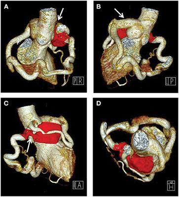 Case Report: Congenital Coronary Artery Ring With Single Left Coronary Ostium and Fistula: A Previously Unreported Anatomy